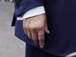 Trump Didiagnosis Alami Insufisiensi Vena Kronis, Apa Itu?