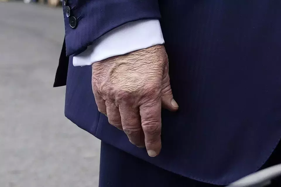 Trump Didiagnosis Alami Insufisiensi Vena Kronis, Apa Itu? 1 insufisiensi vena kronis